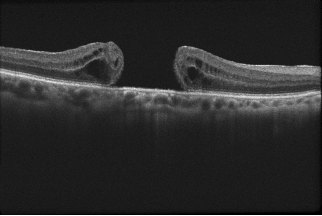 OCT Buraco Macular