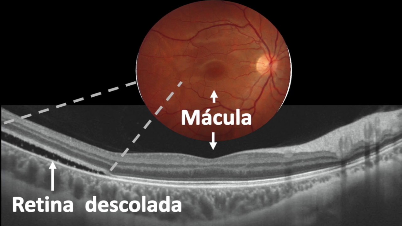 OCT Descolamento de Retina