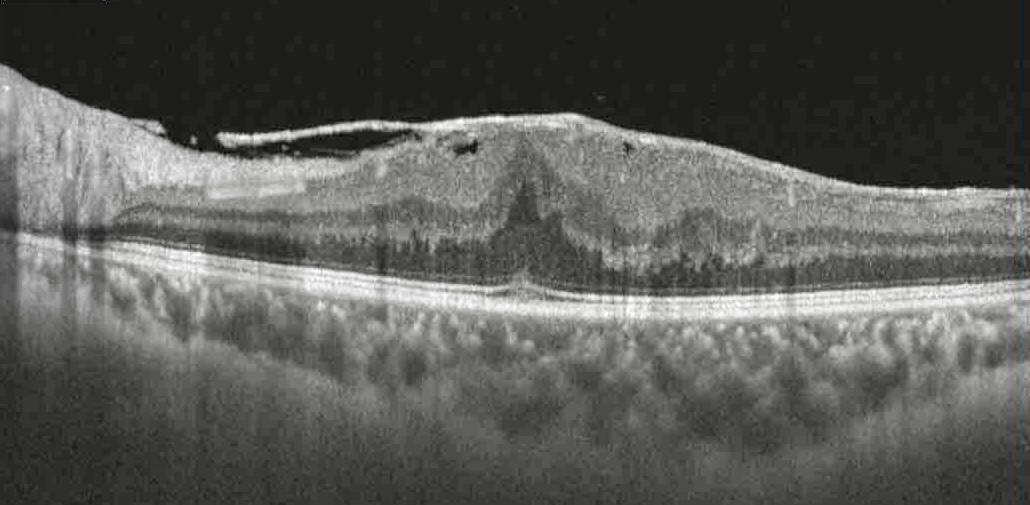 OCT Membrana Epirretiniana